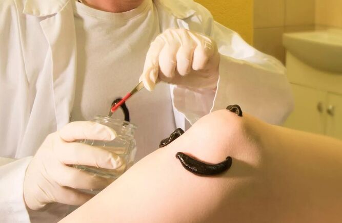 Hirudoterapia per vene varicose
