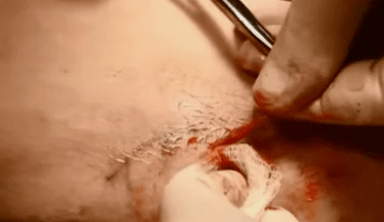 tipi di operazioni per rimuovere le vene varicose