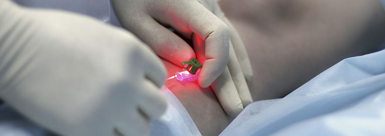 Scleroterapia compressiva