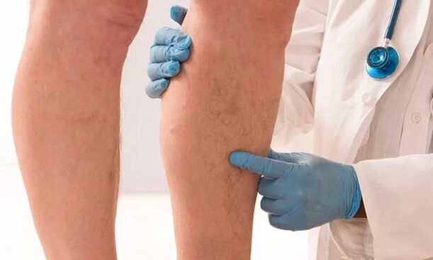 il medico esamina le gambe per le vene varicose